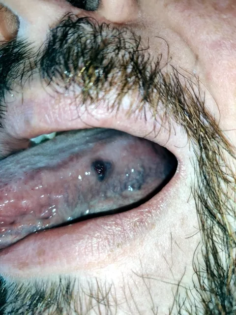 Red lump on tongue - very rare, begign Masson's tumor. Surgically removed later