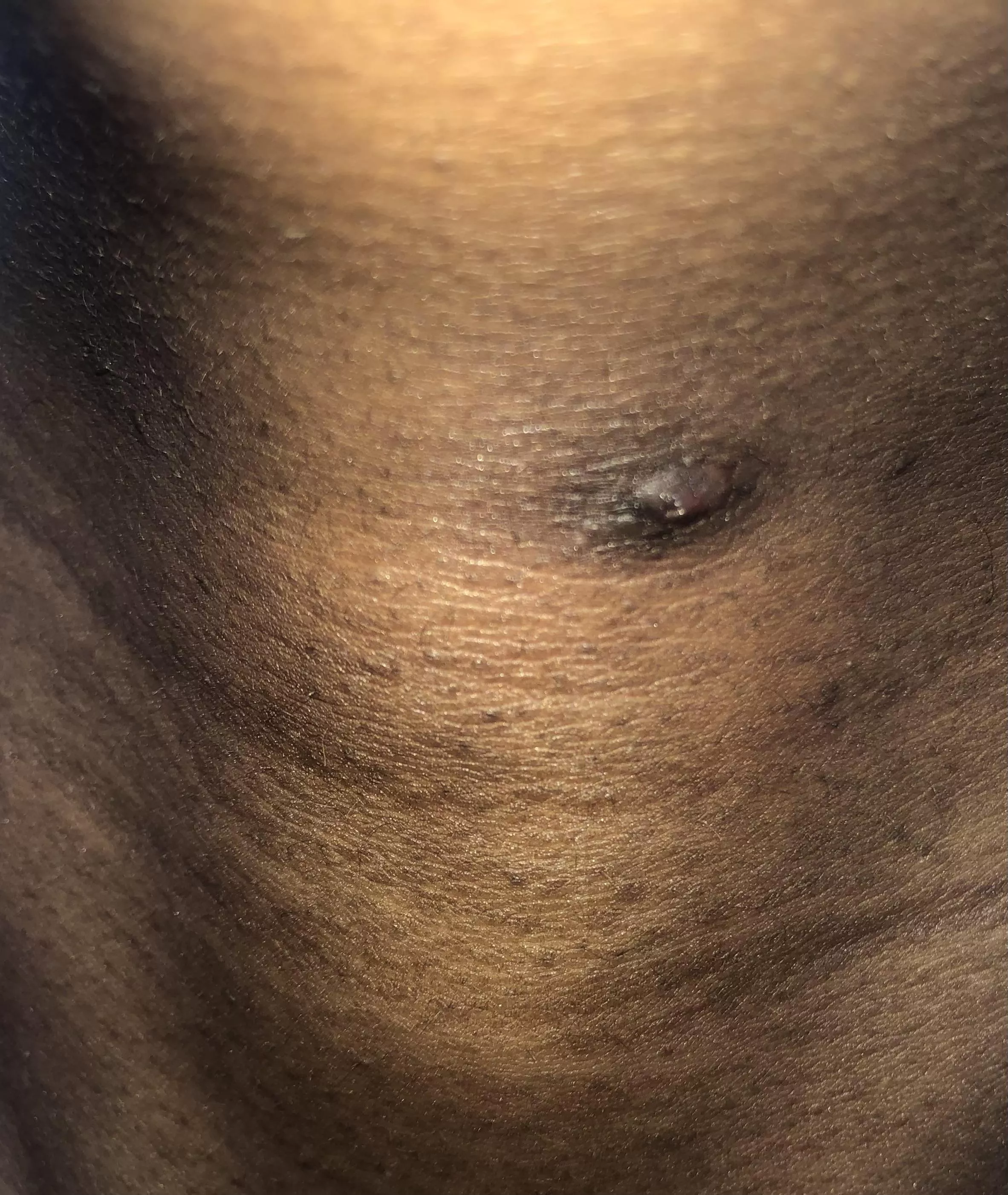 Removed ingrown hair now this. I try to pop it but it feels hard and when I squeeze it a little clear loquid comes out. It has a tiny hole in the middle. It’s been here for a year. I peeled the scarring off. I wanna squeeze it but it hurts. What can I 