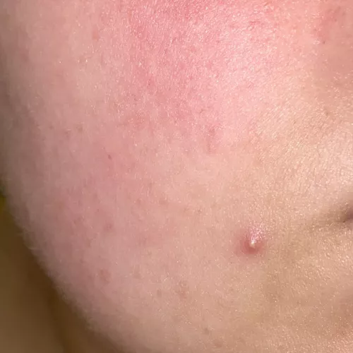 Should I pop it? It’s on my face, how can I do it without scarring?