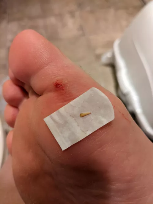 Stepped on a toothpick in December, urgent care got as much of it out as they could. This finally popped yesterday while I was checking on the