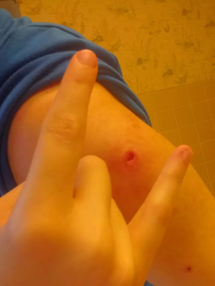 The big ass gnarly hole in my arm after popping a really bad pimple. It felt so much better after I got all the crap out