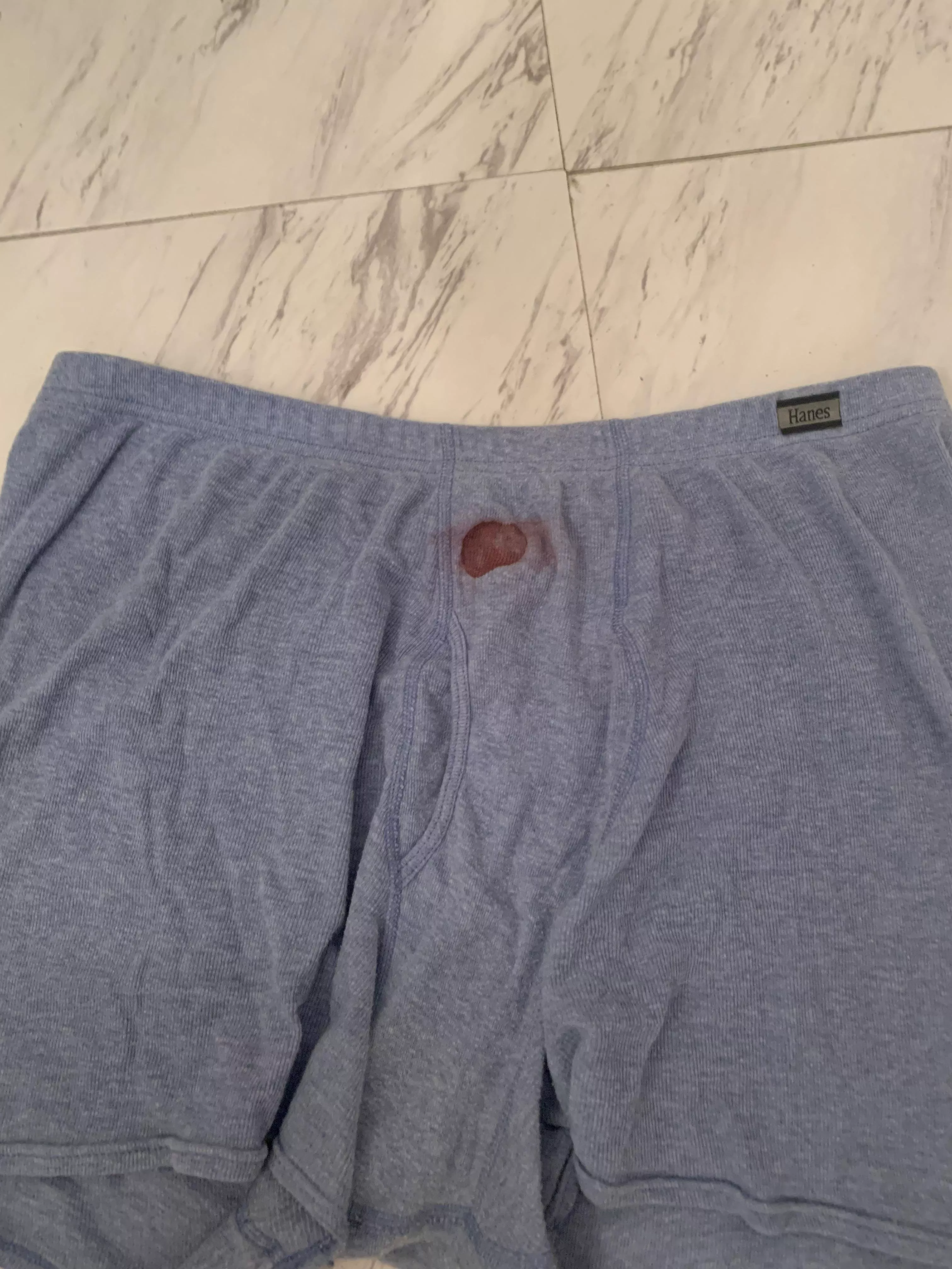 The other night I had a boil pop in my sleep. Here is the aftermath