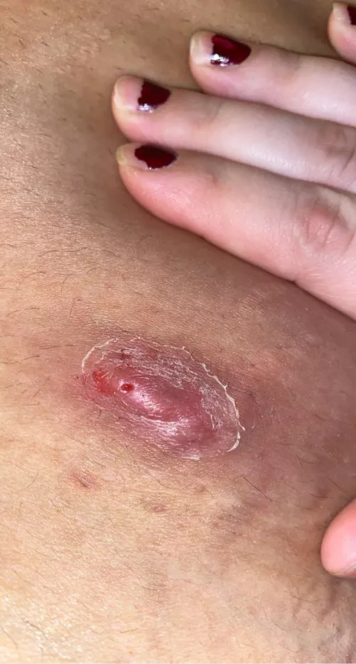 this big boy is on my bf... hurts him to squeeze there’s like 5 heads on it.