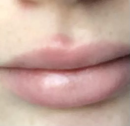 This big boys is hella painful and will not come to a head This big boys is hella painful and will not come to a head