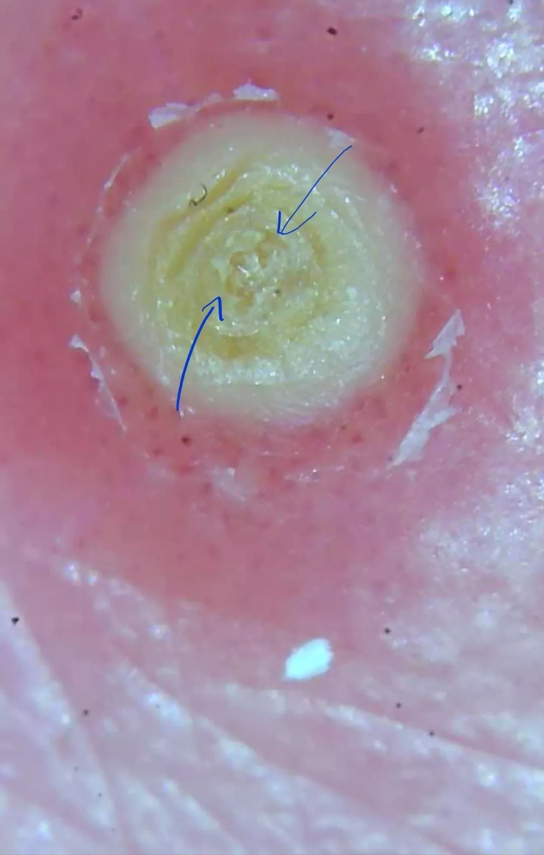 This is on my friends back, she's going to let me pop and video it (I'm doubtful it'll be anything exciting) I had a quick question thought... Does it look like seeds in the middle or am I losing my mind? This is on my friends back, she's going to let me pop and video it (I'm doubtful it'll be anything exciting) I had a quick question thought... Does it look like seeds in the middle or am I losing my mind?