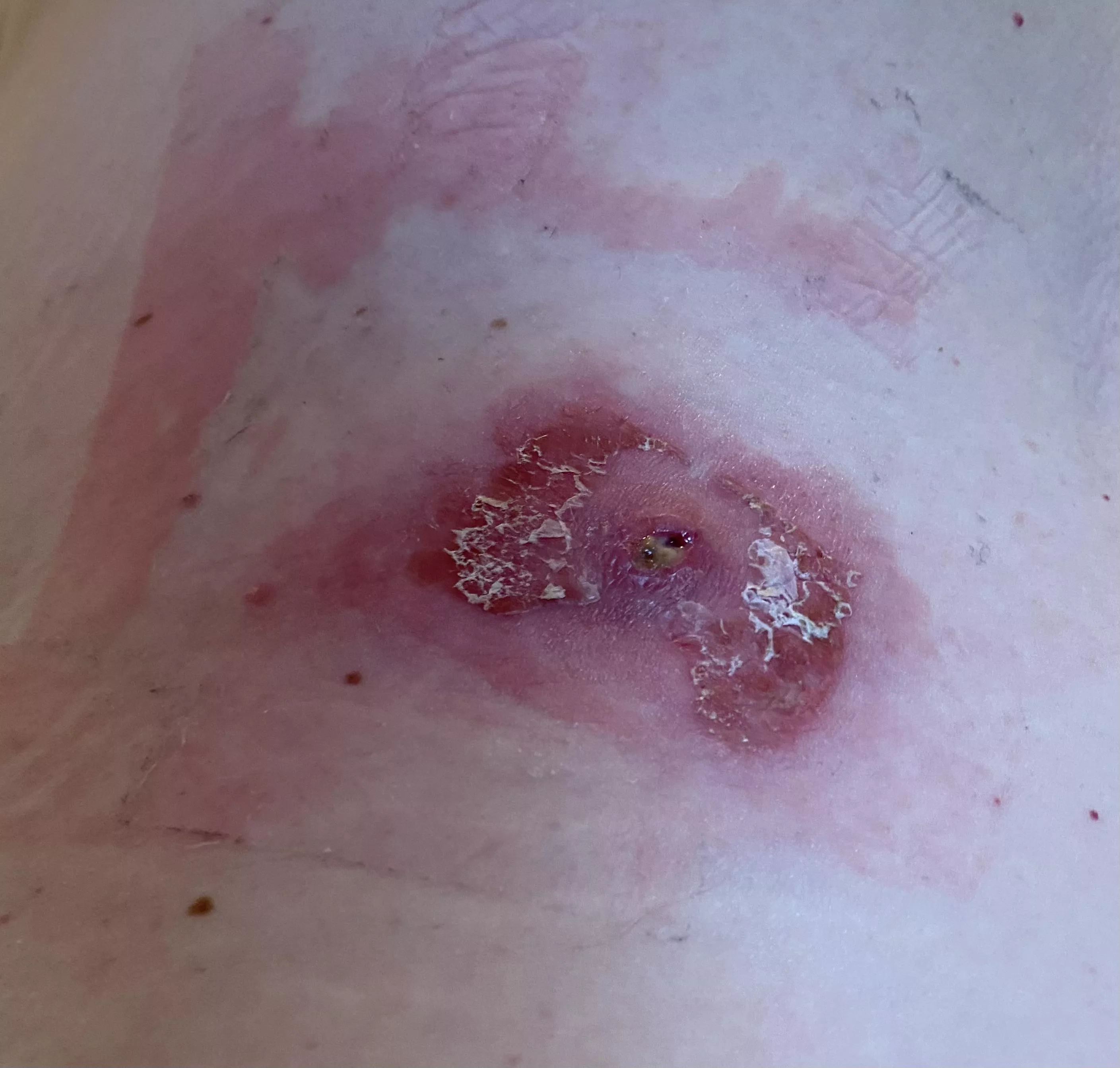 TL;DR - a formerly benign cyst went haywire when my immune system ramped up to fight covid. Had it lanced, then I was allergic to the antibacterial infused bandaids I bought to cover it. I'm in hell.