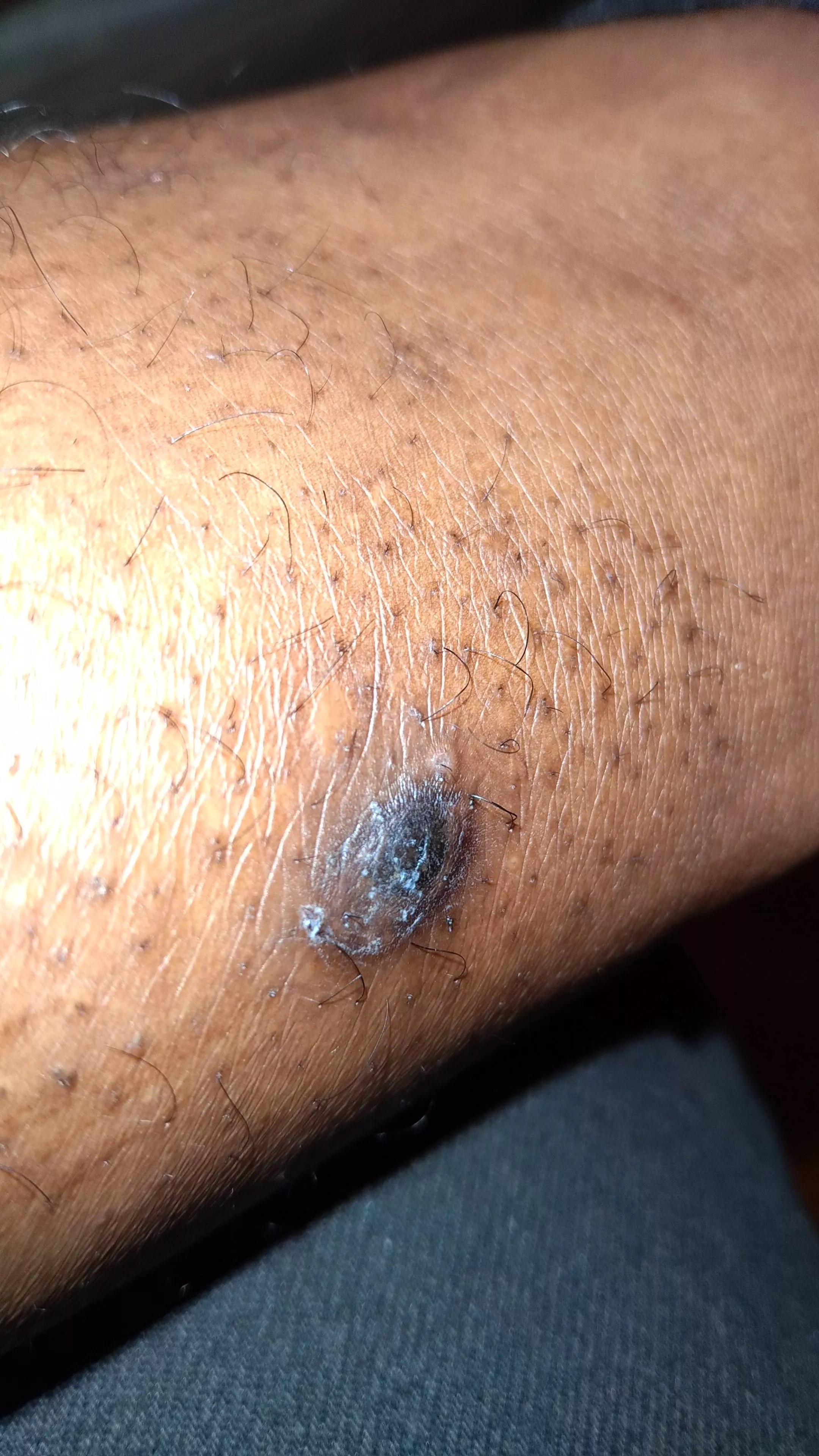 Update: Doctor said it looks like a blister referenced me to a walk in dermatologist