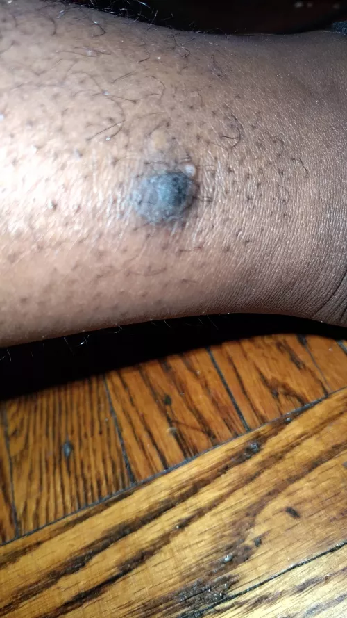 Update Pt 3 still being told it's a blister got an x ray on my leg because it hurts