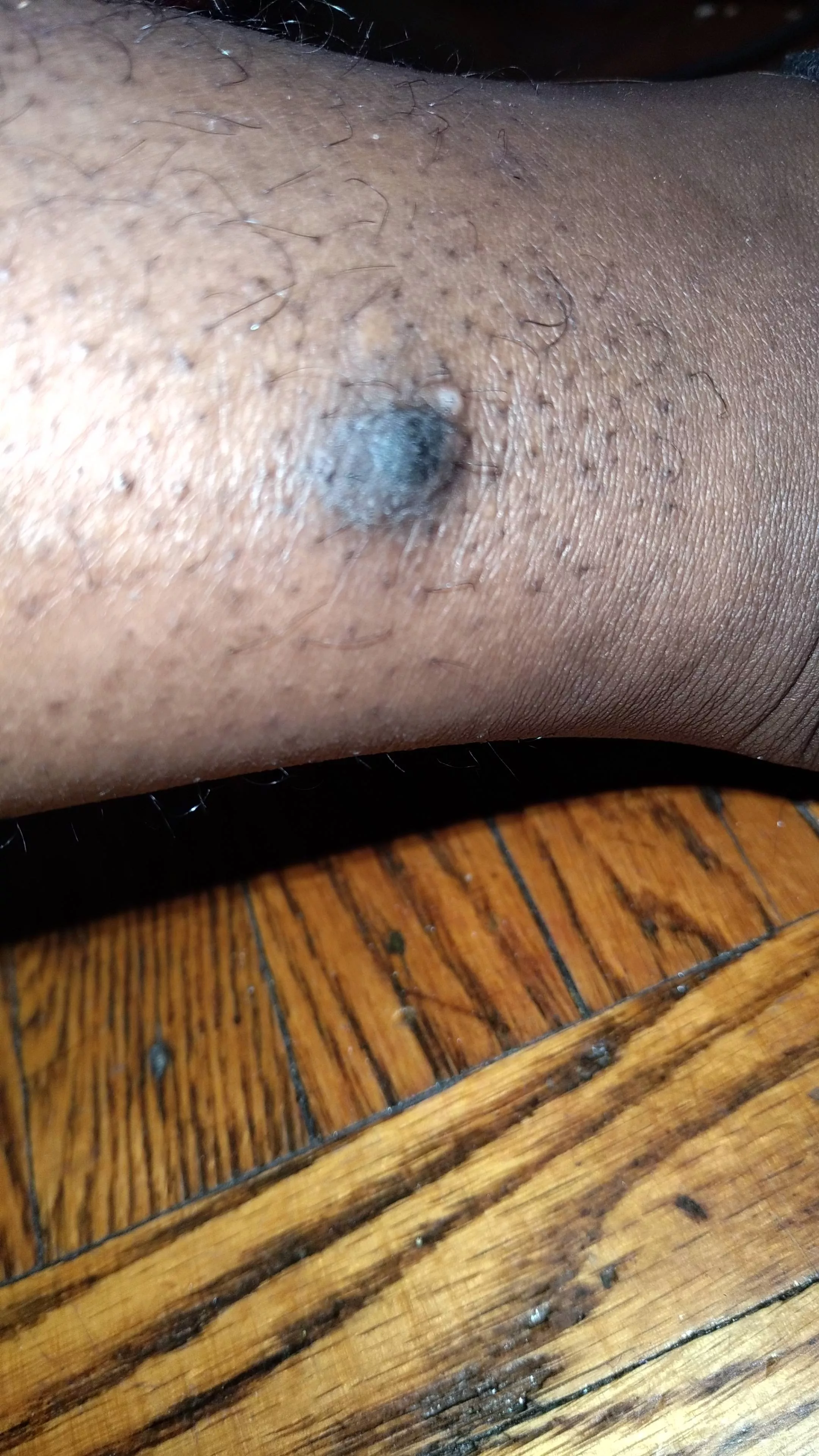 Update Pt 3 still being told it's a blister got an x ray on my leg because it hurts