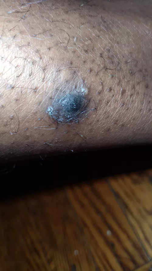 Update Pt.4 Doctor said it looked infected gave me pills and cream.