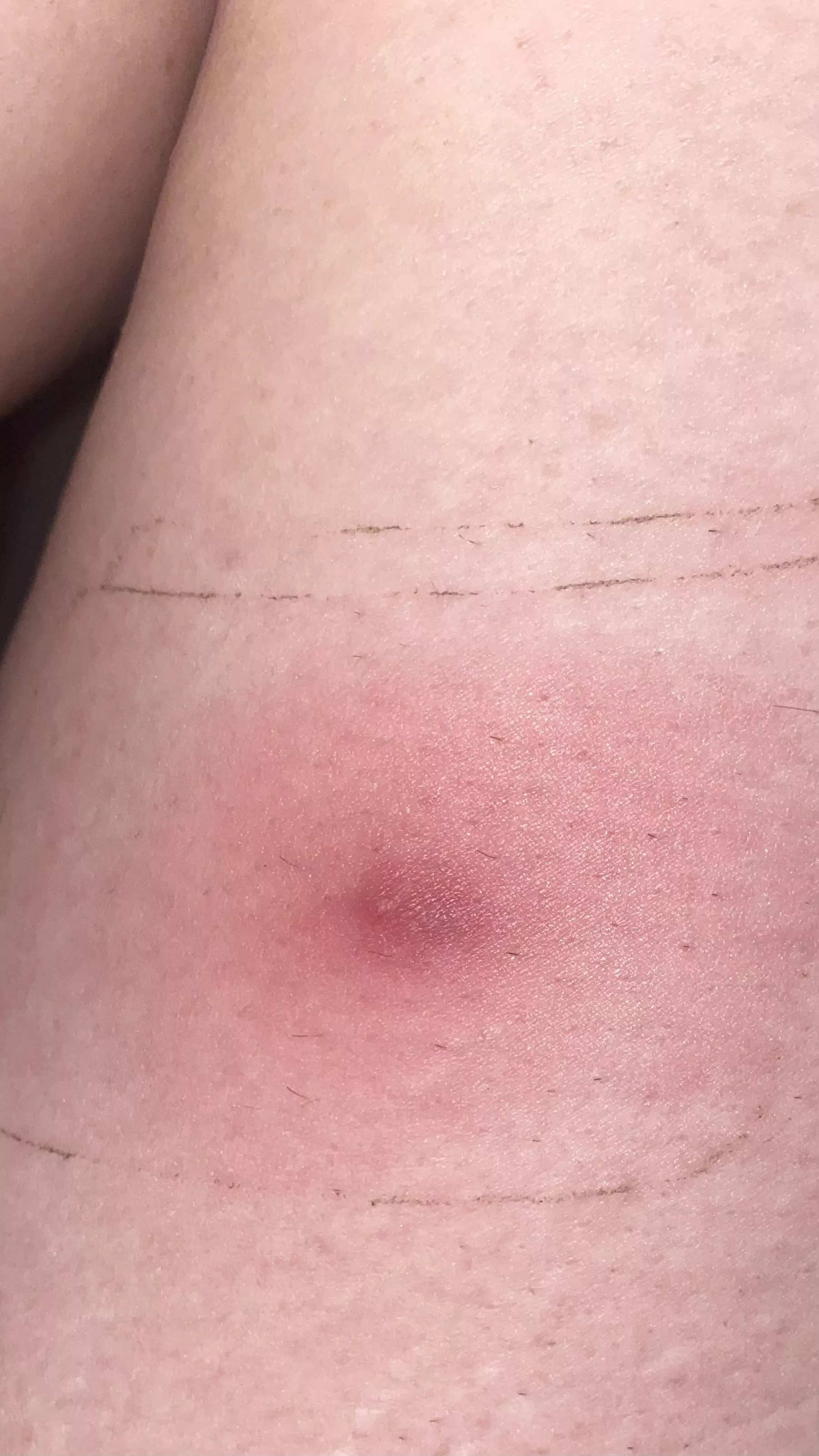 What is this? I originally thought it was a mosquito bite (itchy af) but then it started to get really red/purple?, sore, and hurt to put weight on the leg.. hot compresses don’t seem to be helping. When I put a bandaid and polysporin on it seems to oo