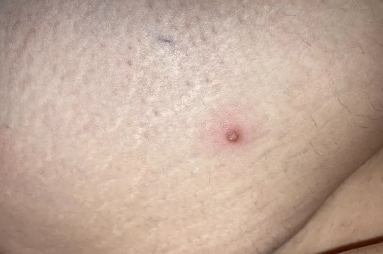Whitehead that popped up over night on the back of my upper thigh.