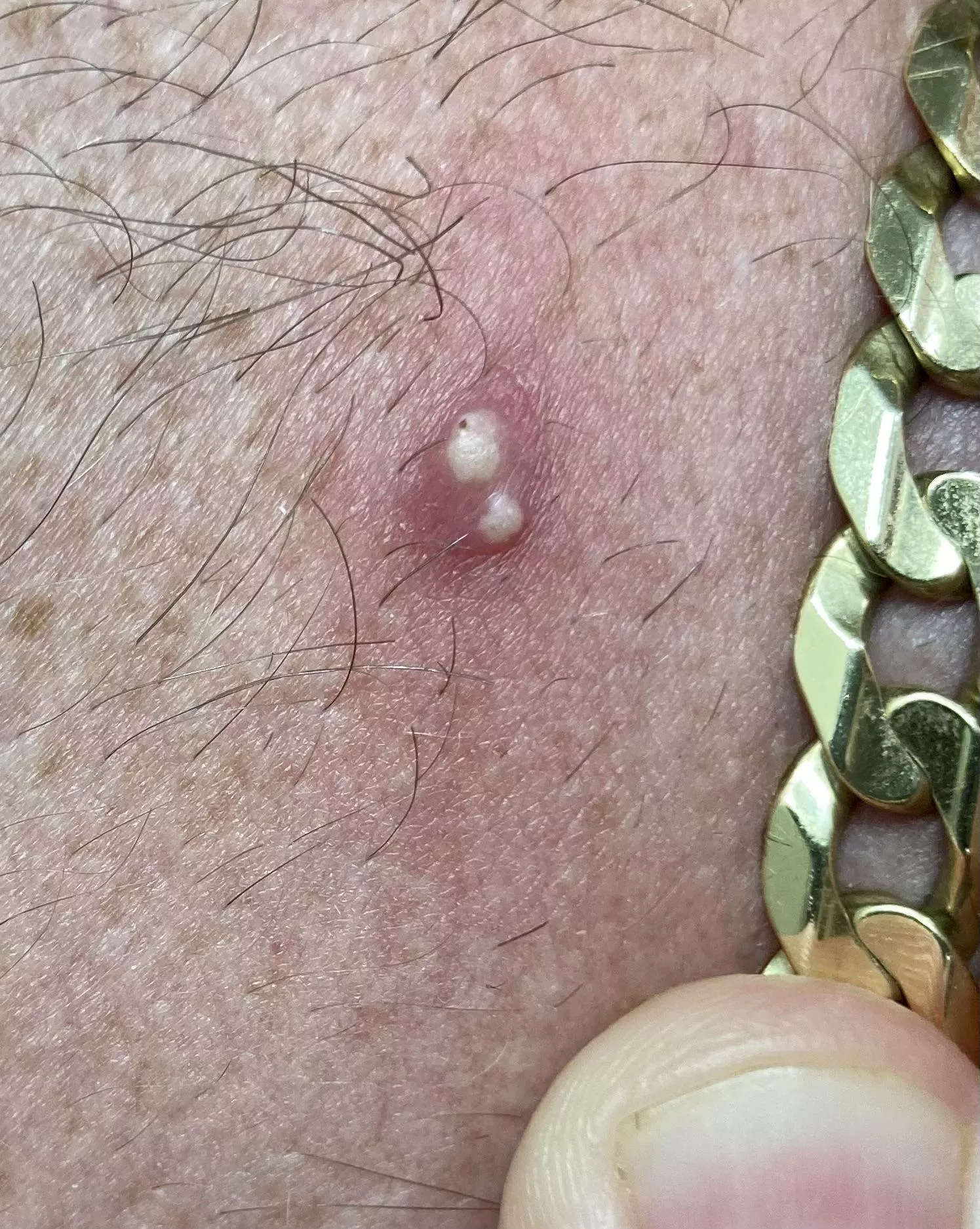 Woke up with 2 holes surrounded by redness on my neck. I thought was a spider bite, but now I’m not sure.