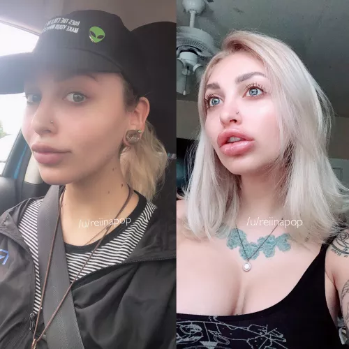 before/after fresyly belached hair + 1 syringe juvederm ultra plus before/after fresyly belached hair + 1 syringe juvederm ultra plus