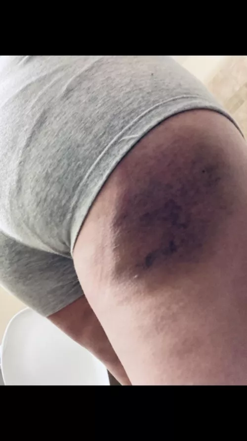 Gotta love a good bruising <3 Gotta love a good bruising <3