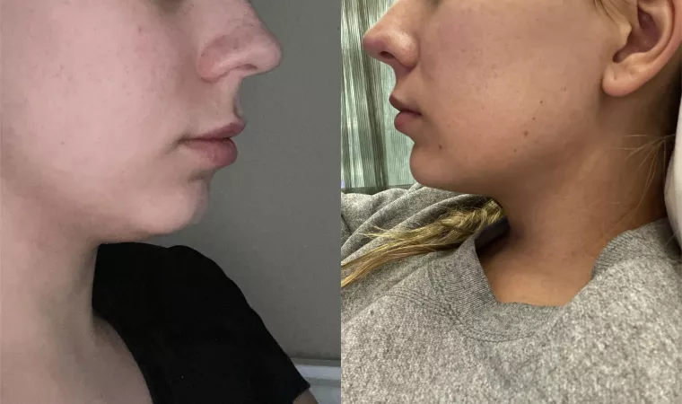 I know that people really love lip filler here, but I decided to show off my chin filler before/after too in case any bimbos are curious! I know that people really love lip filler here, but I decided to show off my chin filler before/after too in case any bimbos are curious!
