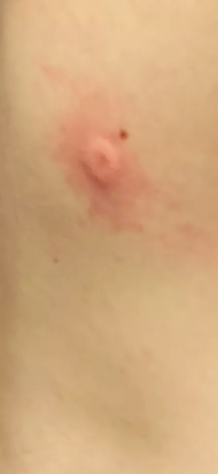 My friend shot my friend with a BB gun and grew an inverted nipple out of his back My friend shot my friend with a BB gun and grew an inverted nipple out of his back