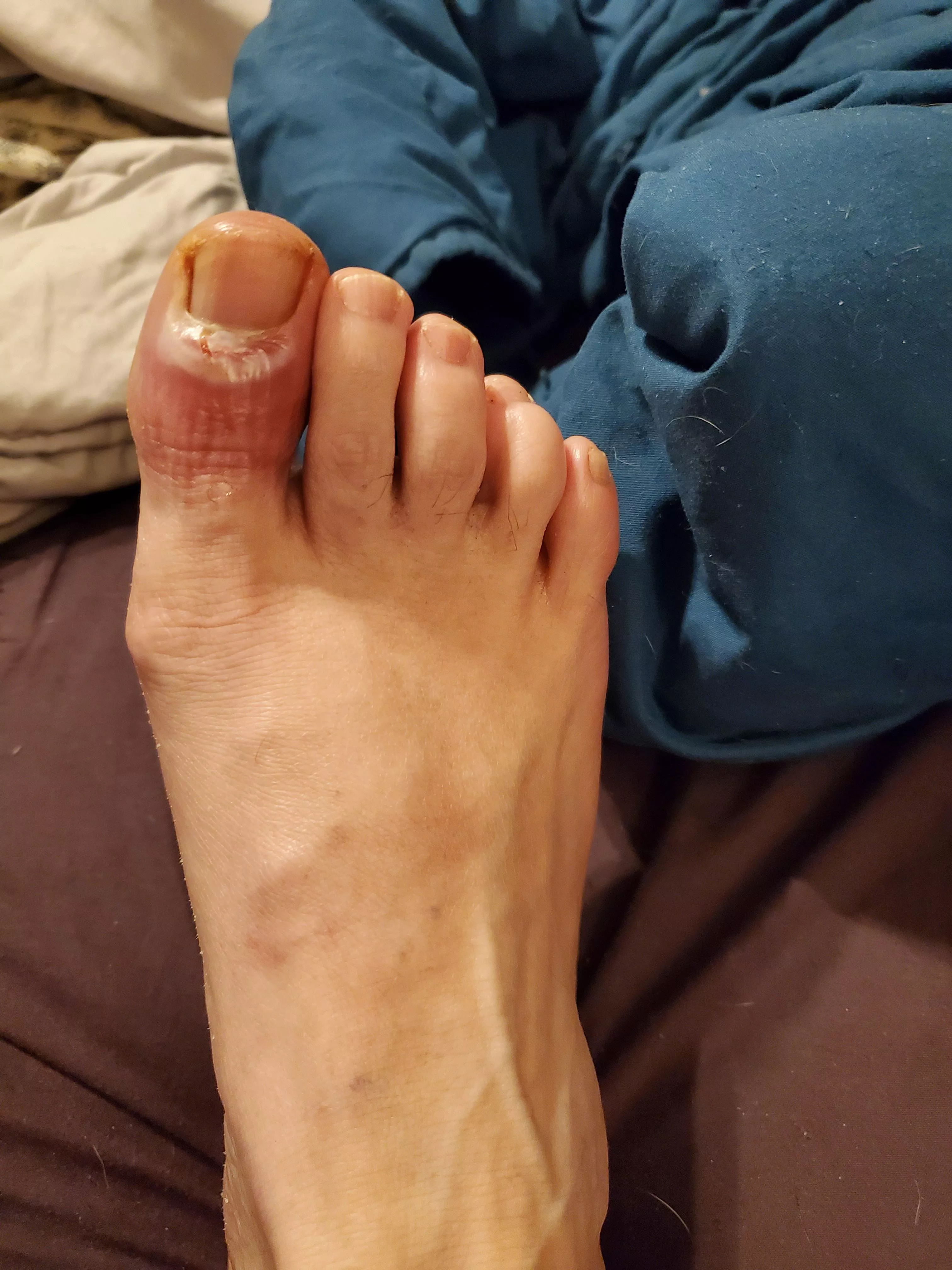 UPDATE: No worse, but no better either. Then I got a call from Urgent Care. The cultures came back, and this particular infection is resistant to my current antibiotics. Tonight I will pick up the new meds...hopefully I can post a more positive update in