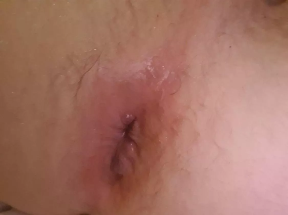 My hole after being used by an anon guy at the park last night. He had a huge cock and put two loads inside me. It felt amazing