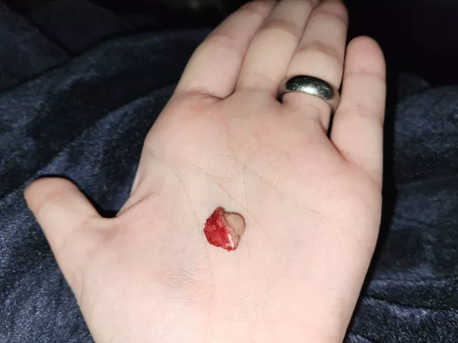 Skin tag I removed on my own with a scalpel, quite large!