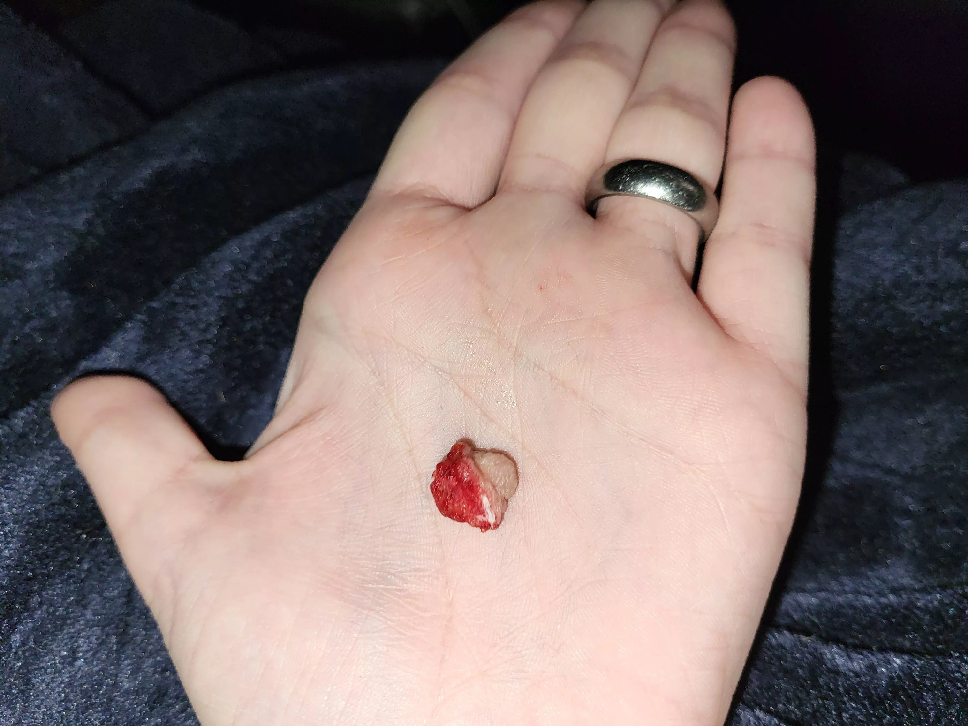 Skin tag I removed on my own with a scalpel, quite large!