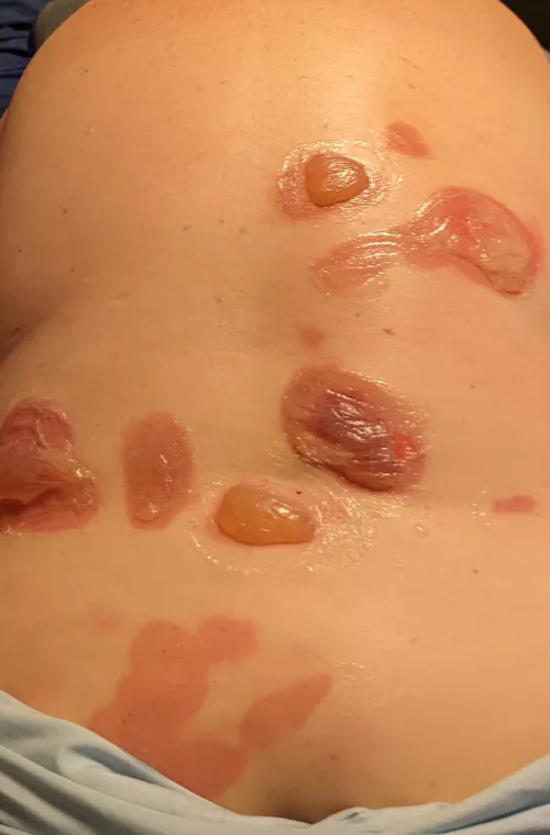 Dry ice blisters on my back