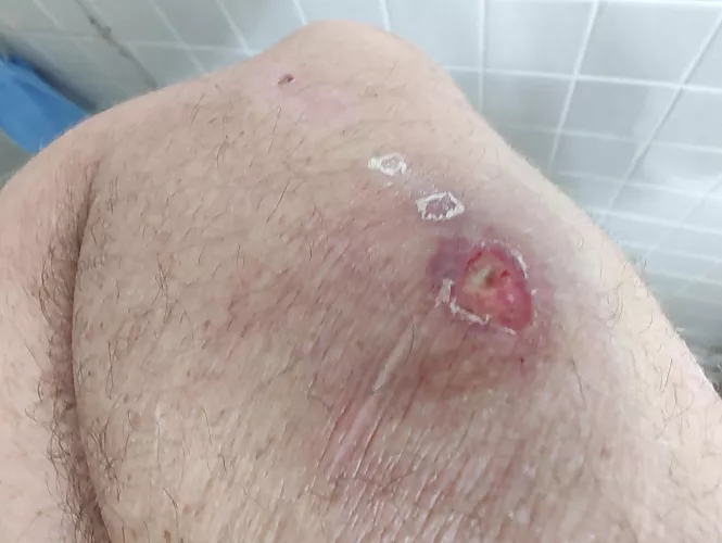 Brown Recluse bite. First it was a large blister, now this. On meds waiting on labs.