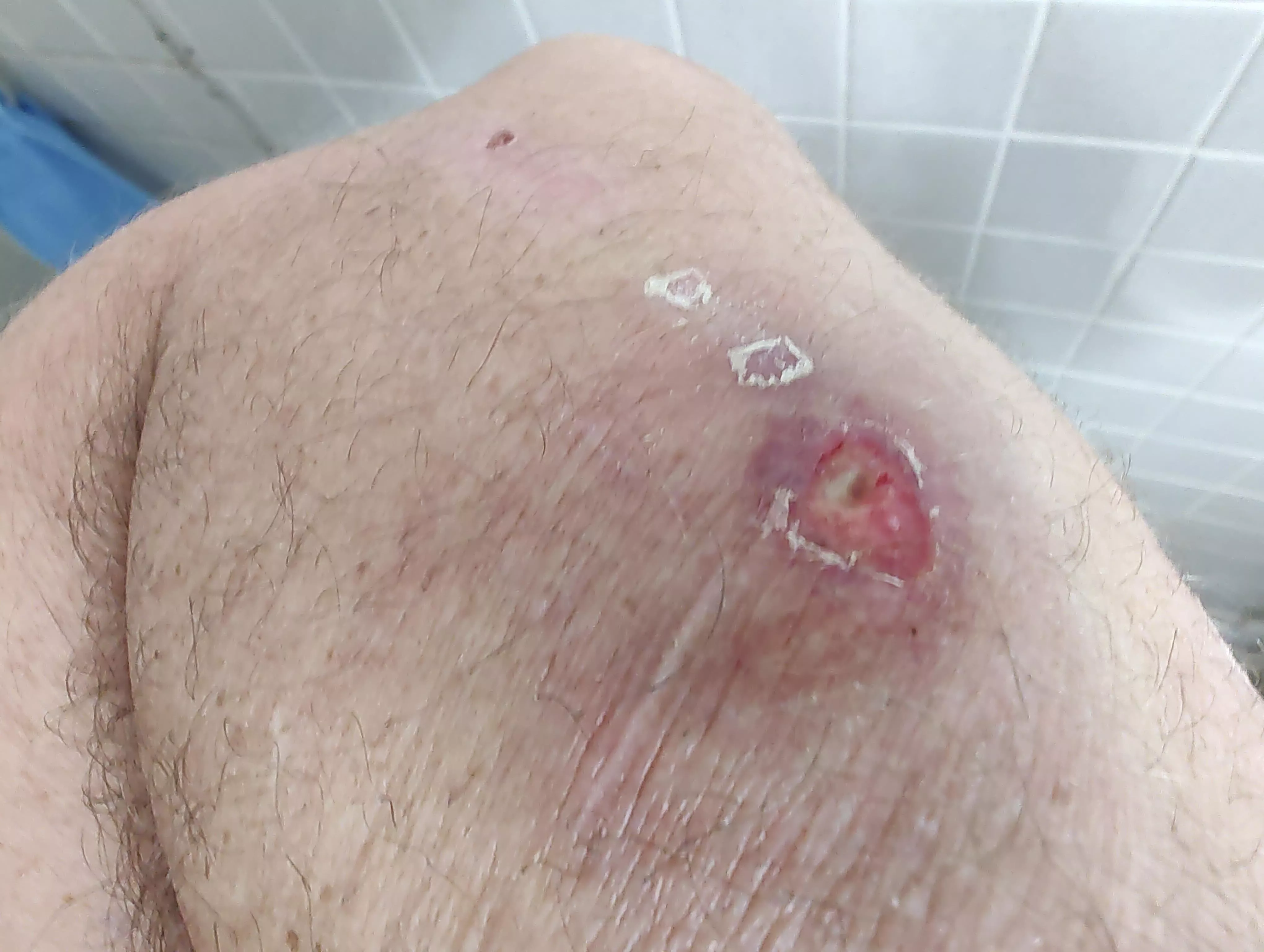 Brown Recluse bite. First it was a large blister, now this. On meds waiting on labs.