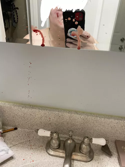 Had this hard, tender lump on my cheek for over 2 weeks. After a hot shower today, I felt it open up some. Applied just slight pressure beside it and this shot out. Currently bandaged up and hoping it fades away on its own. I didn’t think much was goin