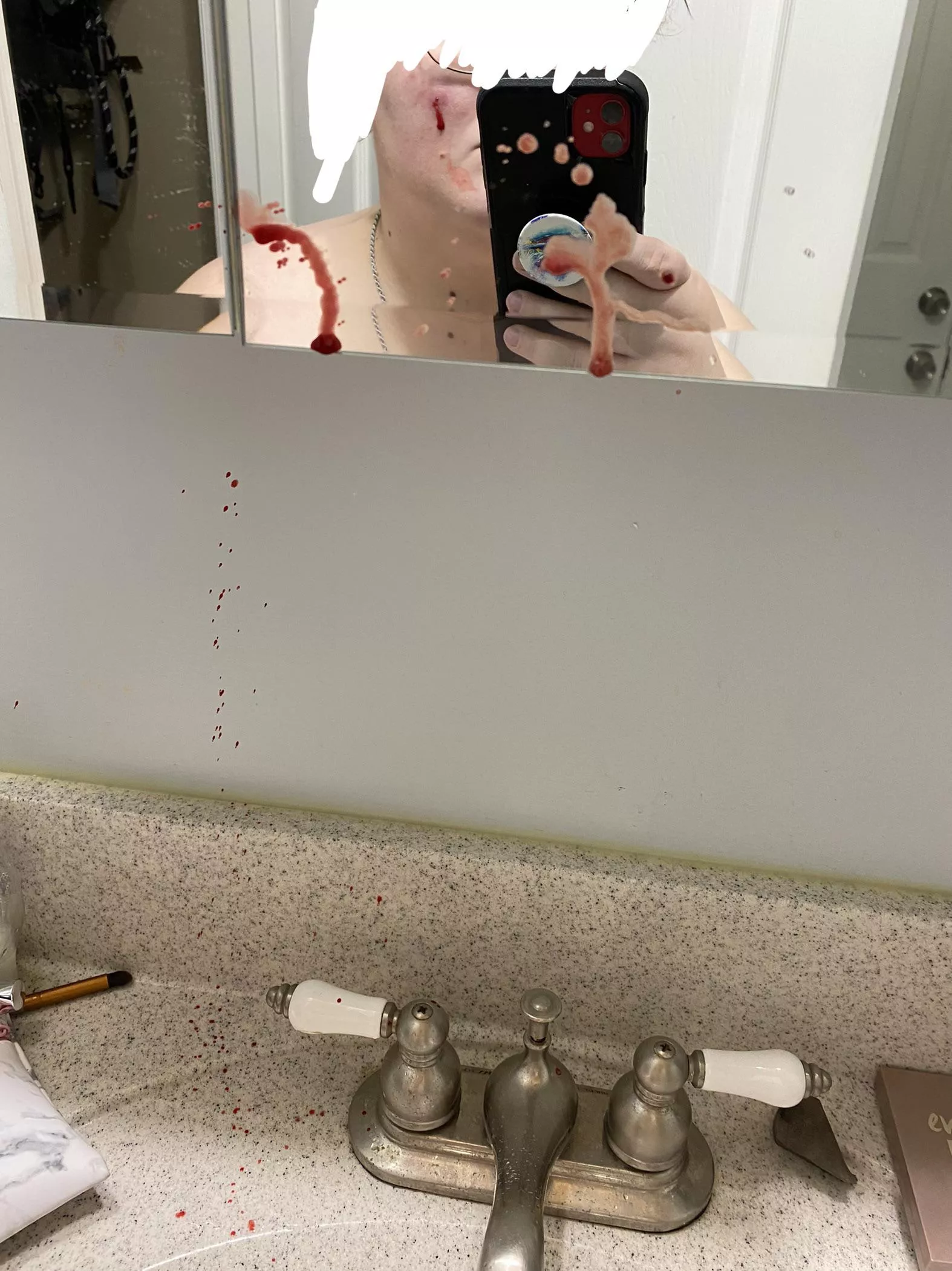 Had this hard, tender lump on my cheek for over 2 weeks. After a hot shower today, I felt it open up some. Applied just slight pressure beside it and this shot out. Currently bandaged up and hoping it fades away on its own. I didn’t think much was goin