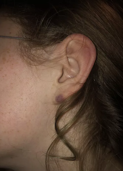 What is this bruise like thing on my girlfriend’s left ear lobe?