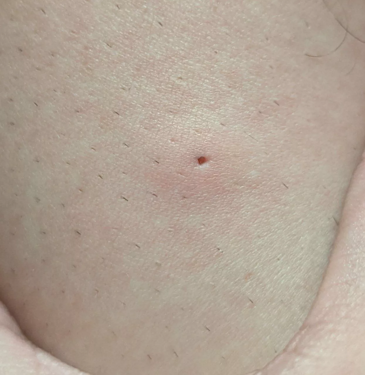 Is this hole from and ingrown hair? I have had it for a long time