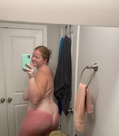 Who’s coming over with the aloe for me?