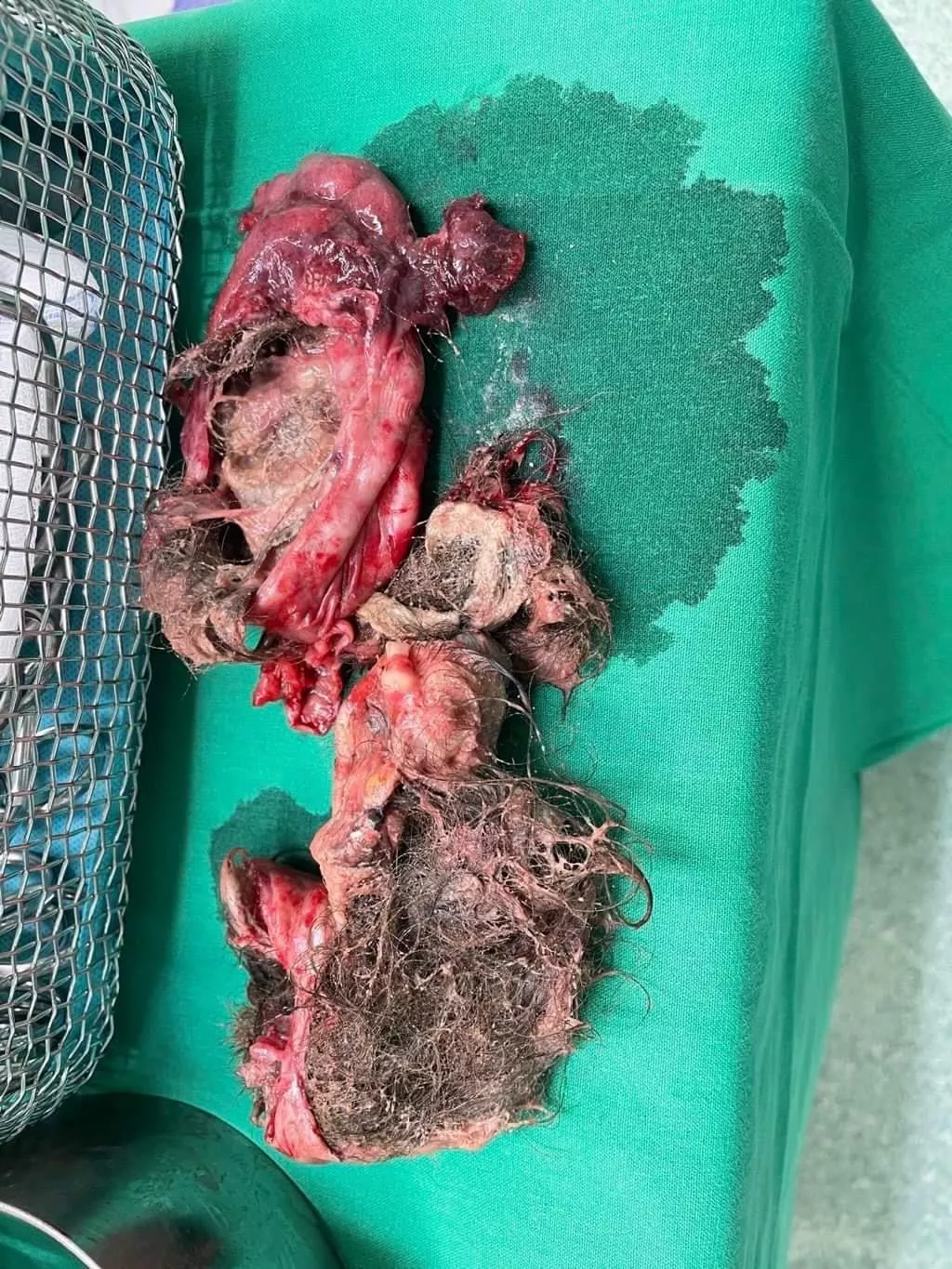 My best friend's hairy teratoma she got removed recently.