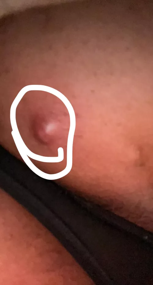 not the best image, but should i try popping this? is it a cyst?