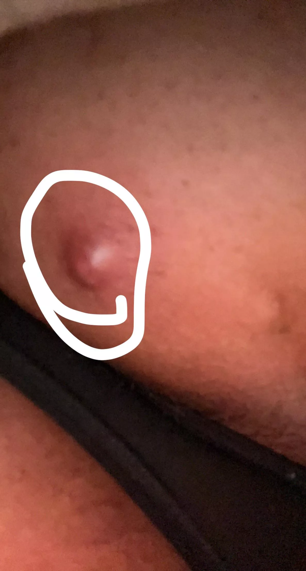 not the best image, but should i try popping this? is it a cyst?