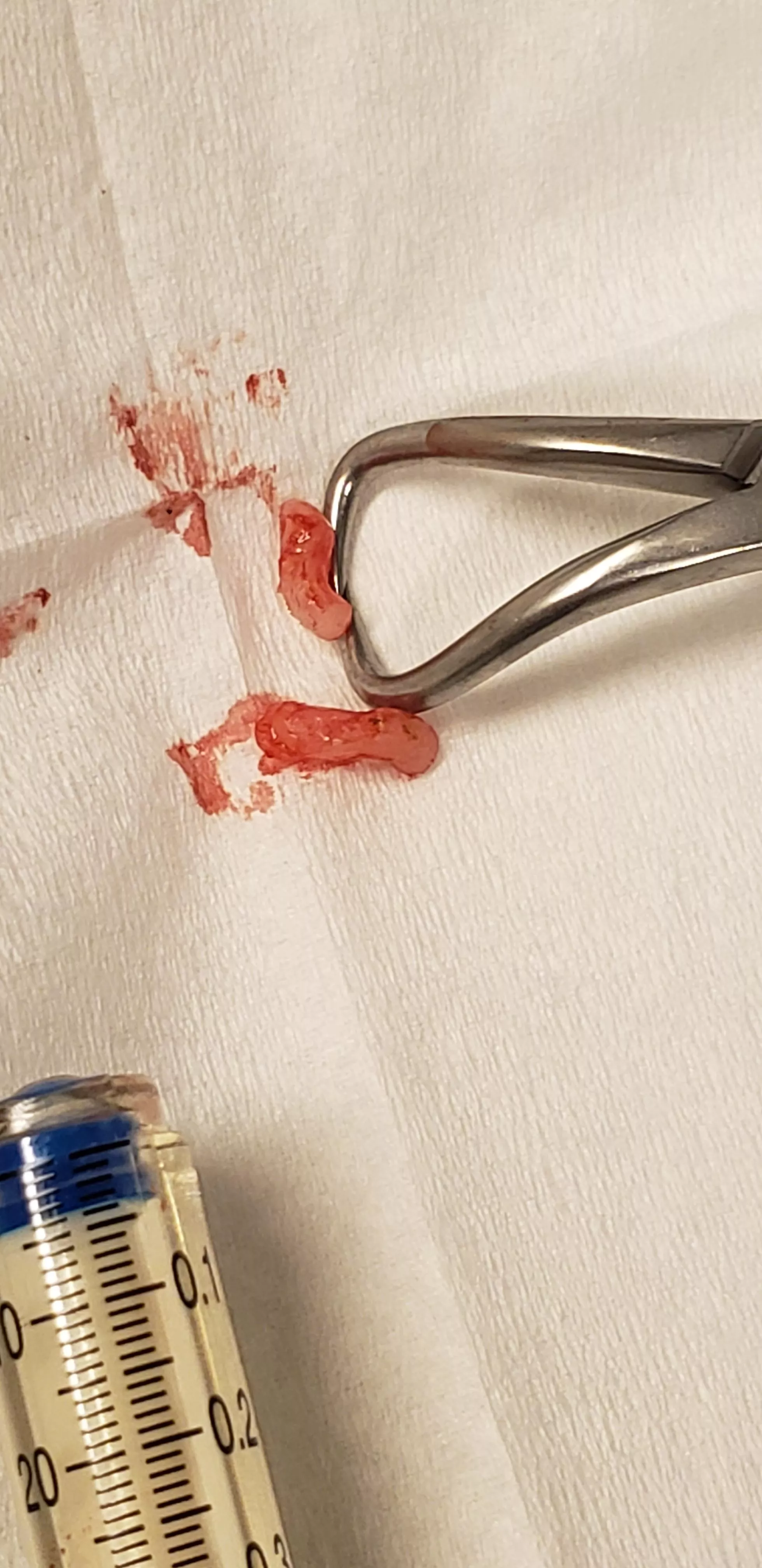 Not sure if this counts. Just got a vasectomy. Got to see the pieces they snipped off. Definitely felt a tug & release sensation that reminded me of pulling out an ingrown hair, so maybe this belongs here?