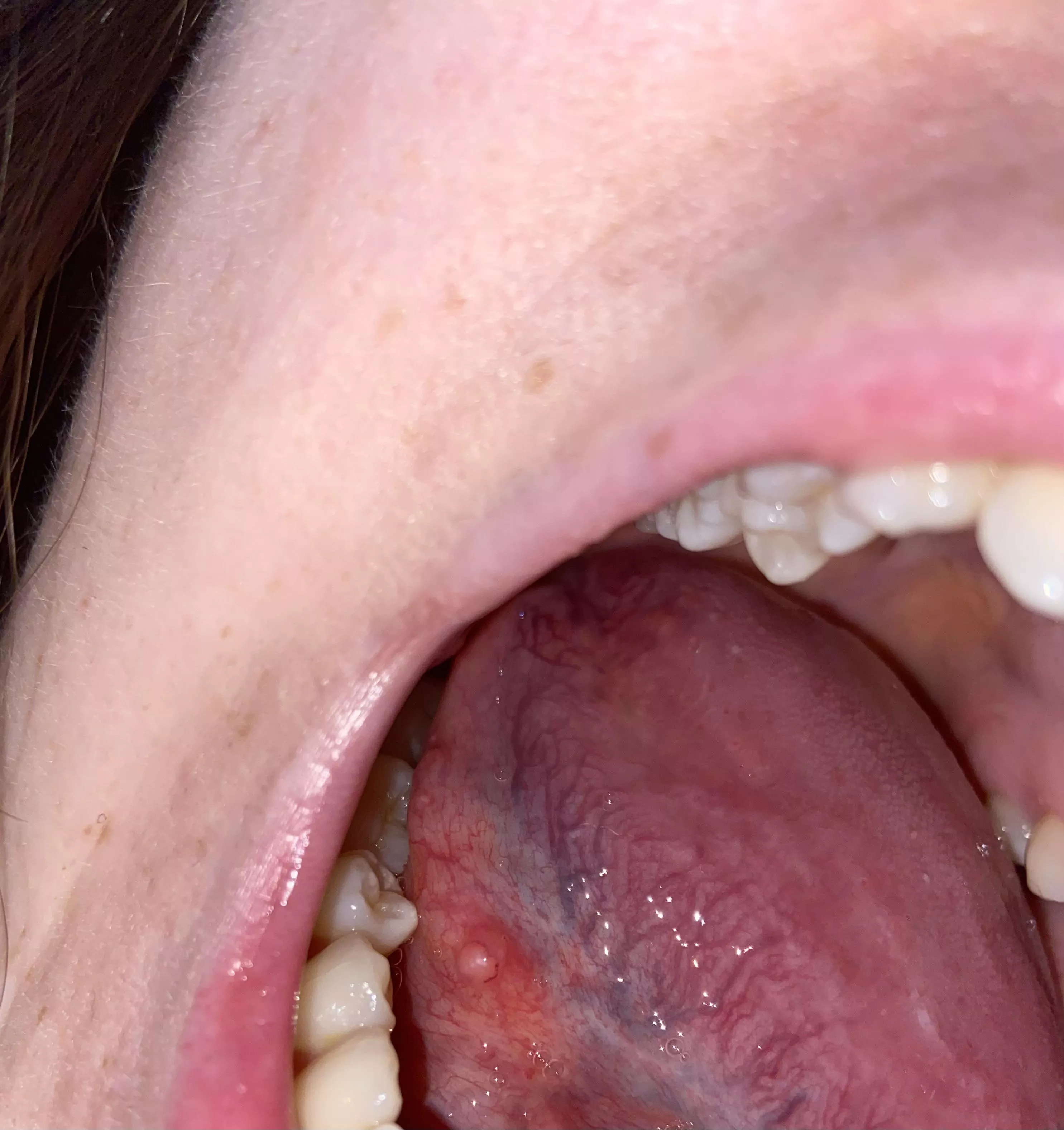 Wtf is this thing on my tongue? Feels like I have food under my tongue constantly. No pain just very annoying. Two days it’s been here now.