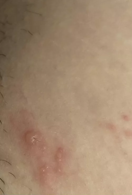 Can anyone tell me what this may be ? I’m freaking out . It’s near my bikini line . Literally just popped up