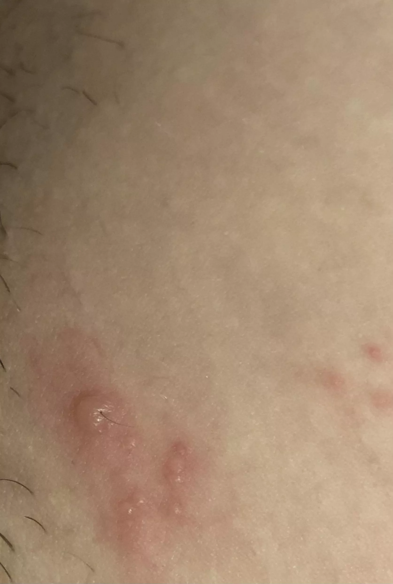 Can anyone tell me what this may be ? I’m freaking out . It’s near my bikini line . Literally just popped up