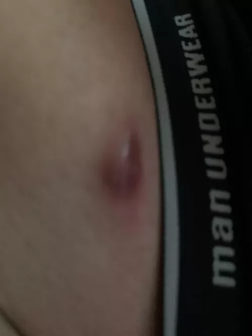 Got this sort of blood boil thing on my belly / belt area, that won't pop. Should I be worried?