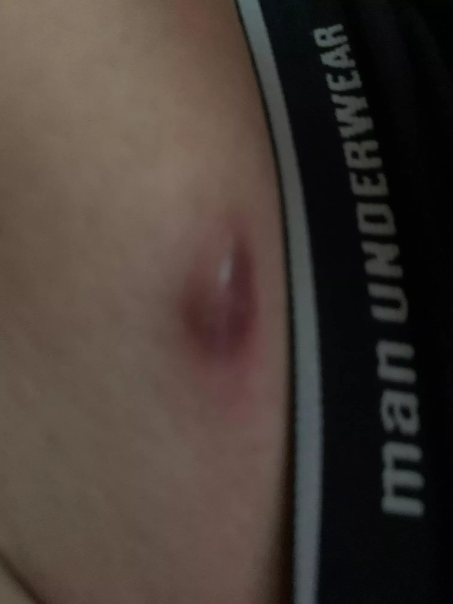 Got this sort of blood boil thing on my belly / belt area, that won't pop. Should I be worried?