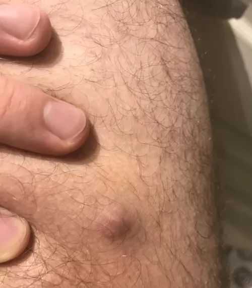 Is this a boil or cyst and should I be concerned?