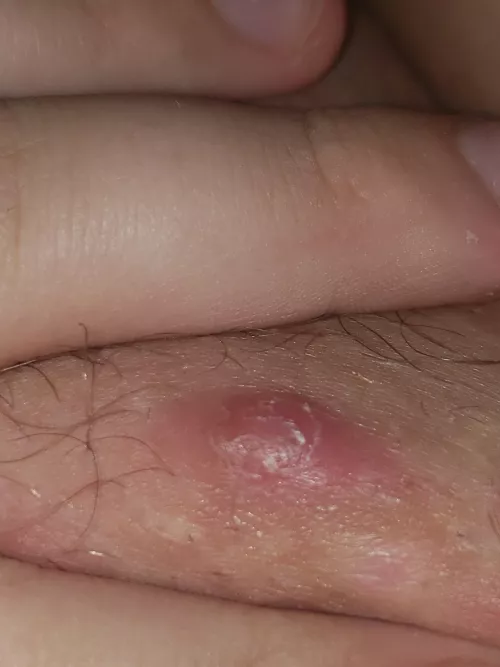 I dont know what this is and it won't pop i messed with it a little bit and all that came out was blood and it then swelled back up
