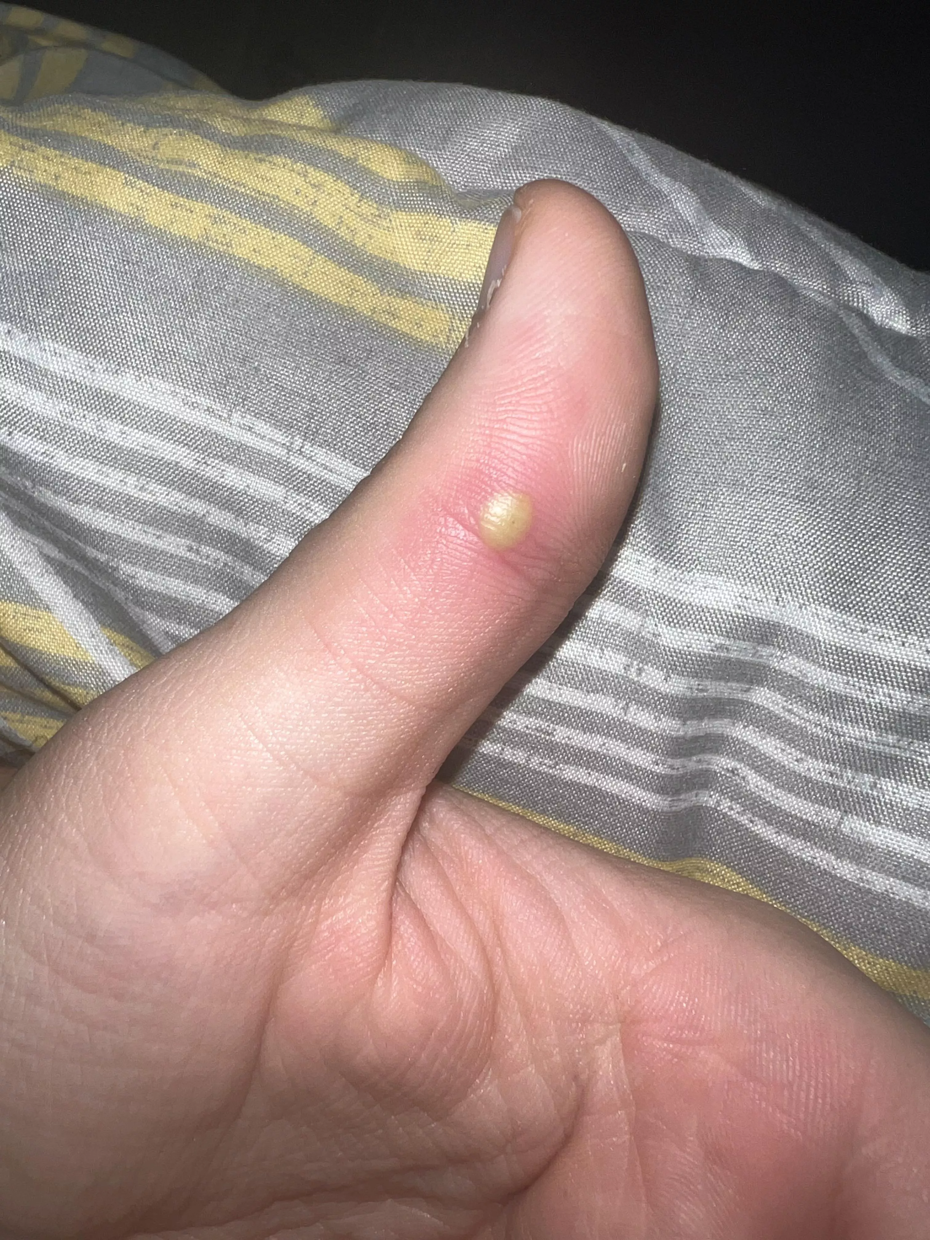 Started from a sand spur that I couldn’t get out. Not sure what it is now. Anyone know what to do?