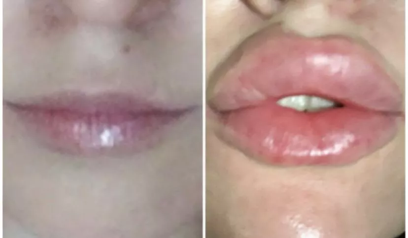 Before and after when I got my last lot of fillers done 💉 I miss this big juicy puffy look and feel! Want me to go bigger? Looking for sponsors 😘