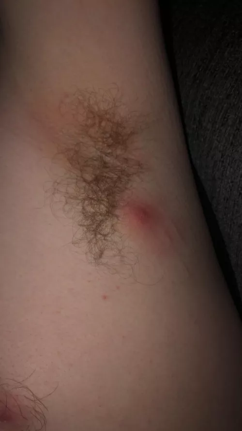 Is this a cyst or a boil? Seems like it's coming to a head, and I can feel a small lump under it