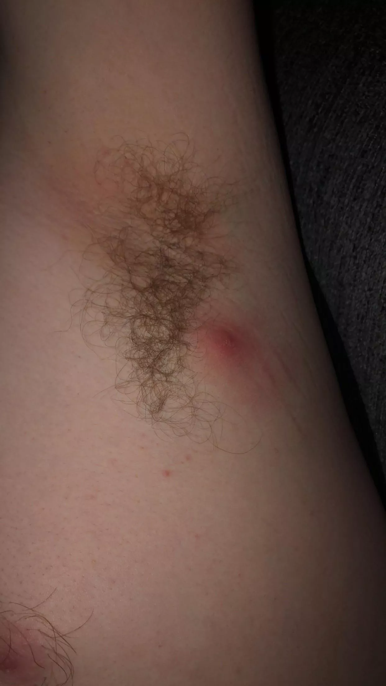 Is this a cyst or a boil? Seems like it's coming to a head, and I can feel a small lump under it