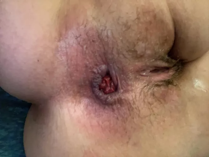 I love how my asshole looks after fucking myself. How would id look if a real dick.