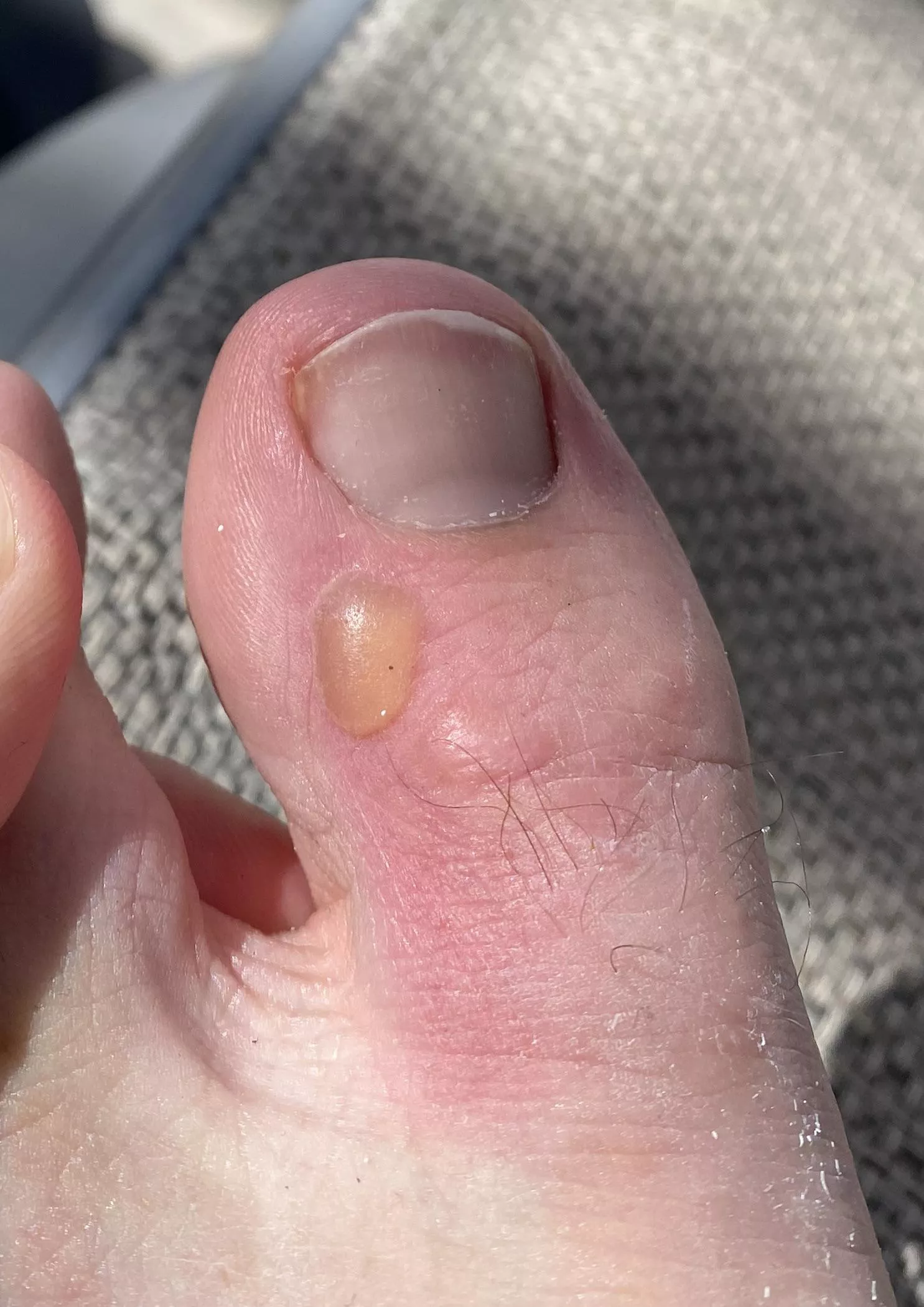 Big ole blister from fins used while snorkeling in Jamaica